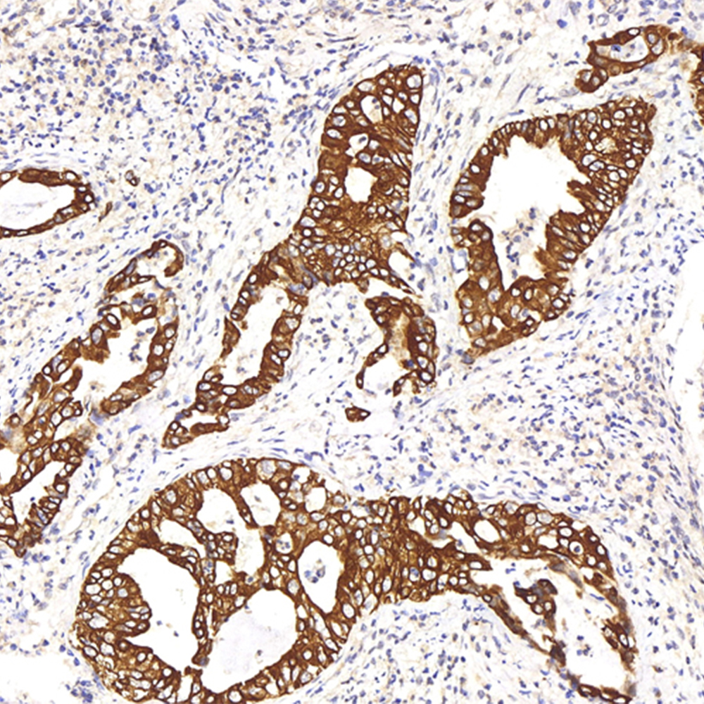 Immunohistochemistry analysis of paraffin-embedded human stomach cancer  using CK-8 Polyclonal Antibody at dilution of 1:200.