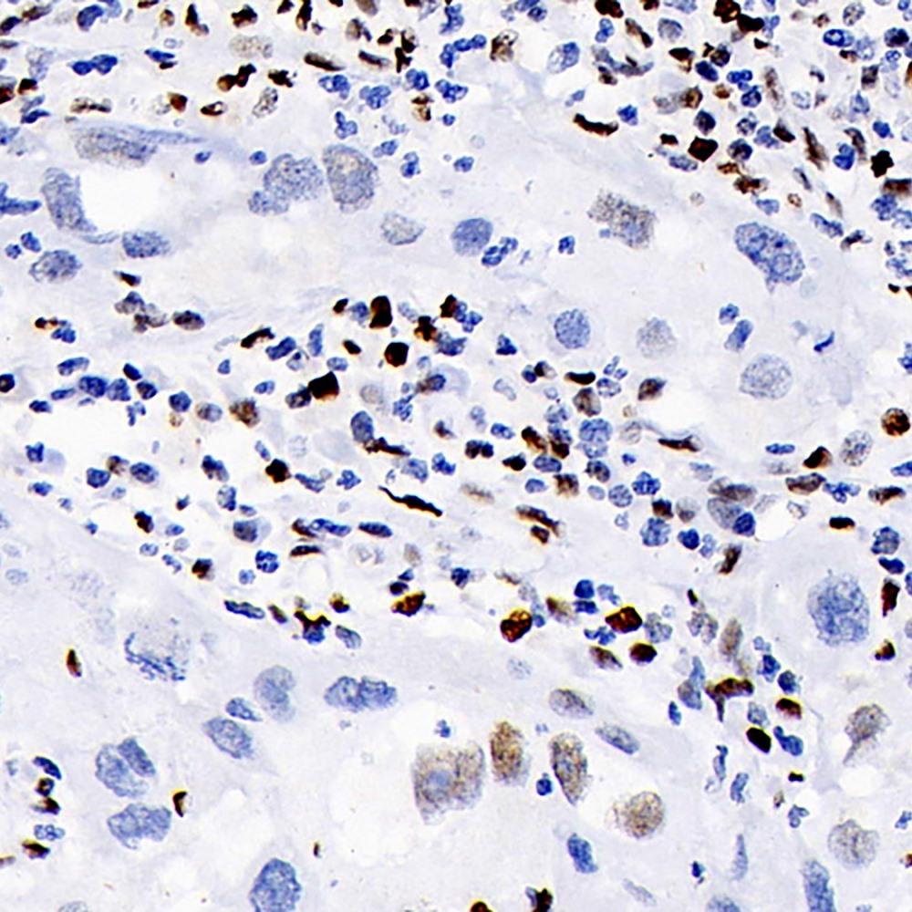 Immunohistochemistry analysis of paraffin-embedded human lymphoma  using ERK 2 Polyclonal Antibody at dilution of 1:100.