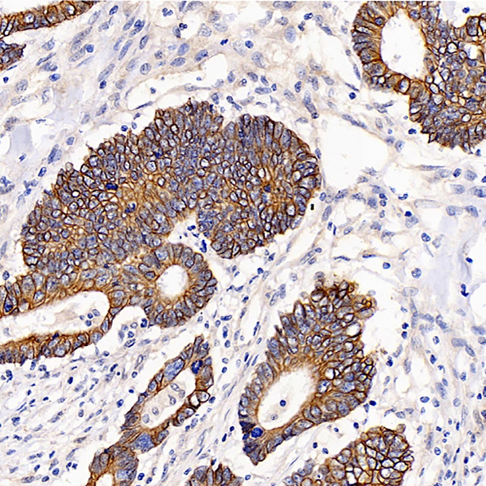 Immunohistochemistry analysis of paraffin-embedded human colon cancer  using BSG Polyclonal Antibody at dilution of 1:200.