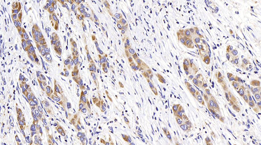 Immunohistochemistry analysis of paraffin-embedded human liver cancer  using ATG7 Polyclonal Antibody at dilution of 1:400.