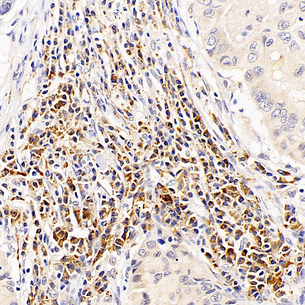 Immunohistochemistry analysis of paraffin-embedded human lung cancer  using CASP1 Polyclonal Antibody at dilution of 1:300.