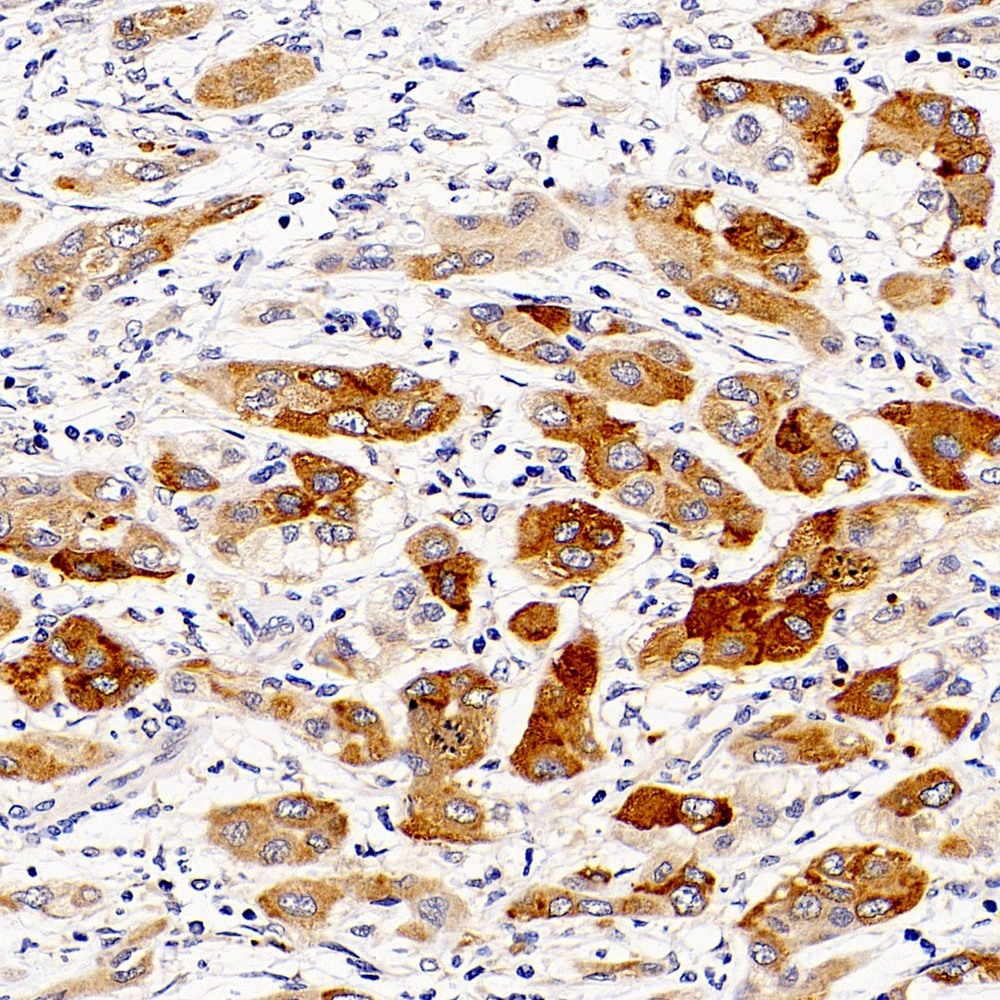 Immunohistochemistry analysis of paraffin-embedded human liver cancer  using CASP1 Polyclonal Antibody at dilution of 1:300.