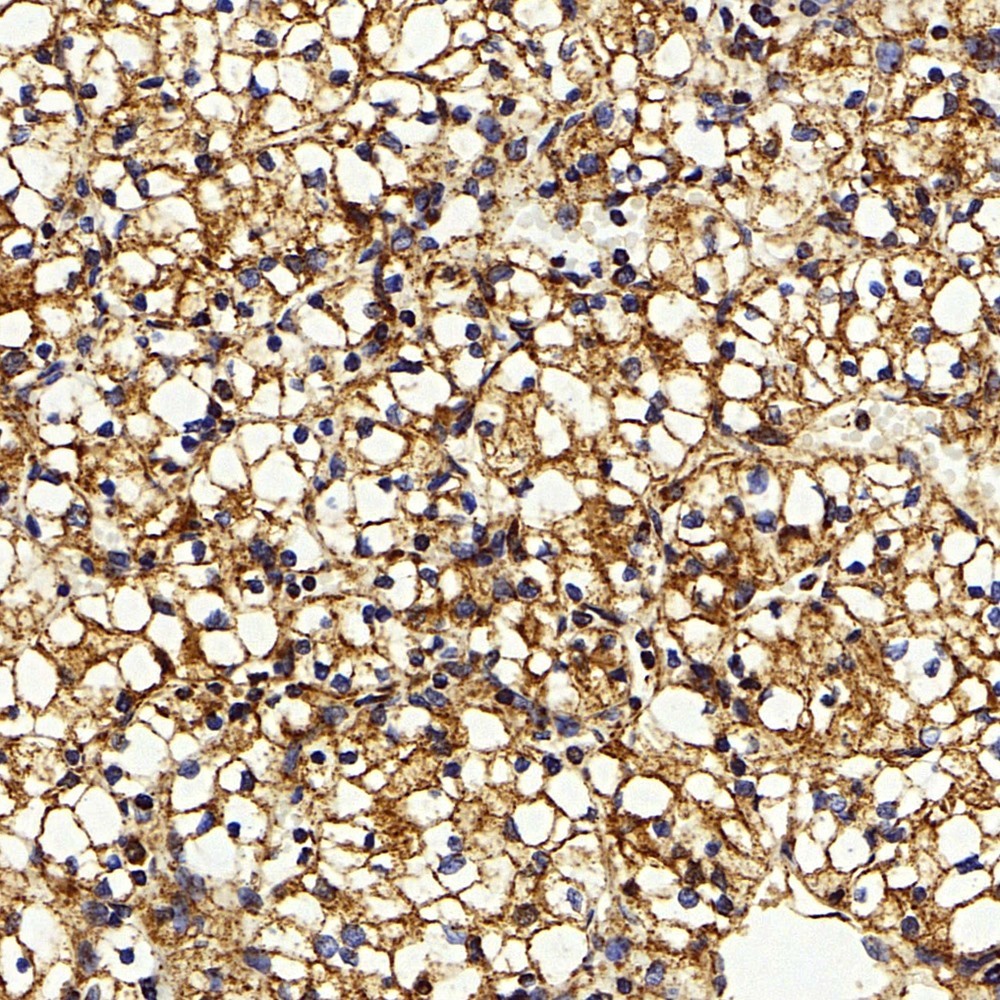 Immunohistochemistry analysis of paraffin-embedded human kidney cancer  using IGF1 Polyclonal Antibody at dilution of 1:500.