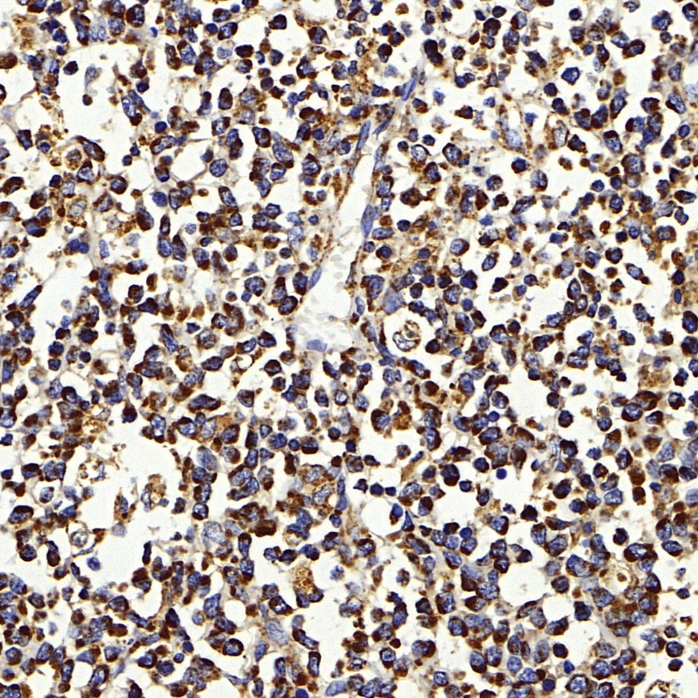 Immunohistochemistry analysis of paraffin-embedded human lymph nodes cancer  using IGF1 Polyclonal Antibody at dilution of 1:500.