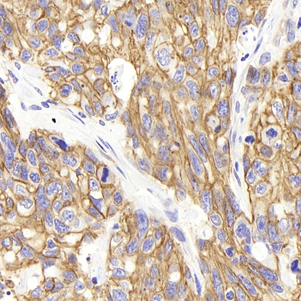 Immunohistochemistry analysis of paraffin-embedded human lymphoma  using Na+/K+-ATPase alpha1 Polyclonal Antibody at dilution of 1:300.