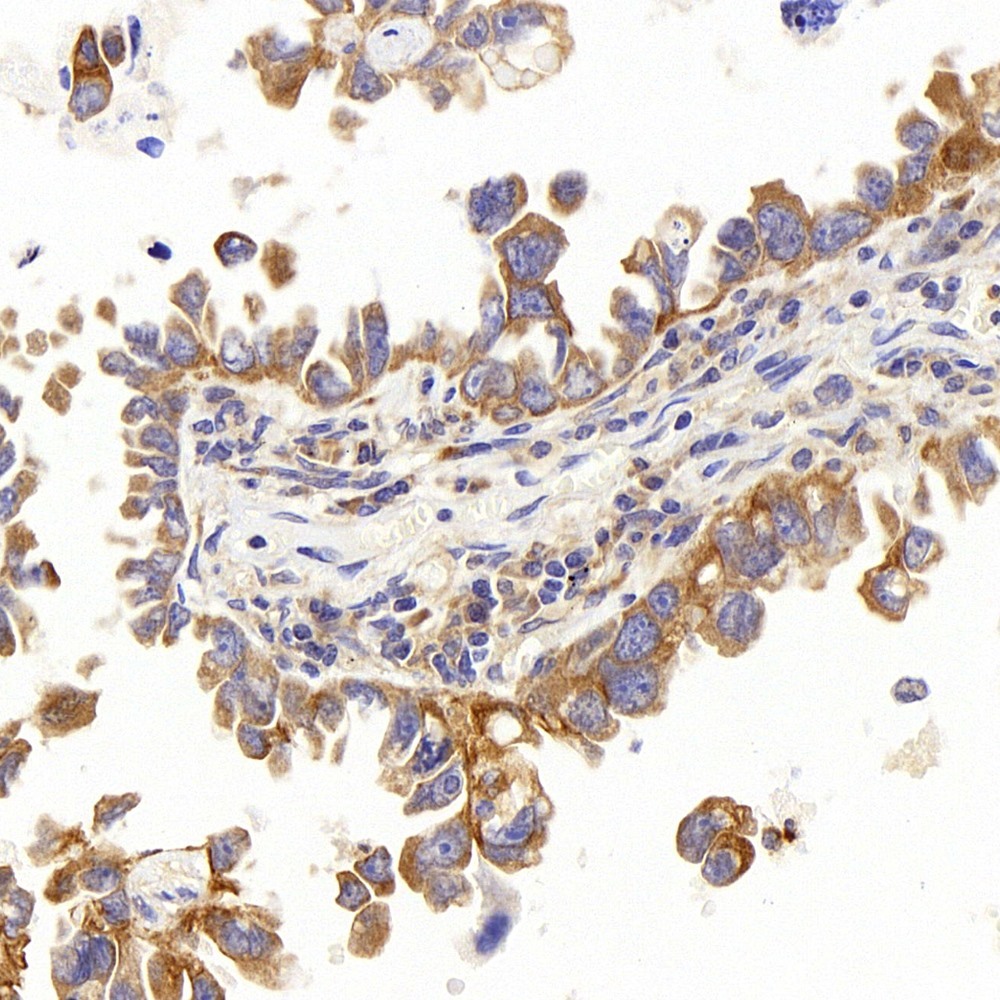 Immunohistochemistry analysis of paraffin-embedded human lung cancer  using PERK Polyclonal Antibody at dilution of 1:400.