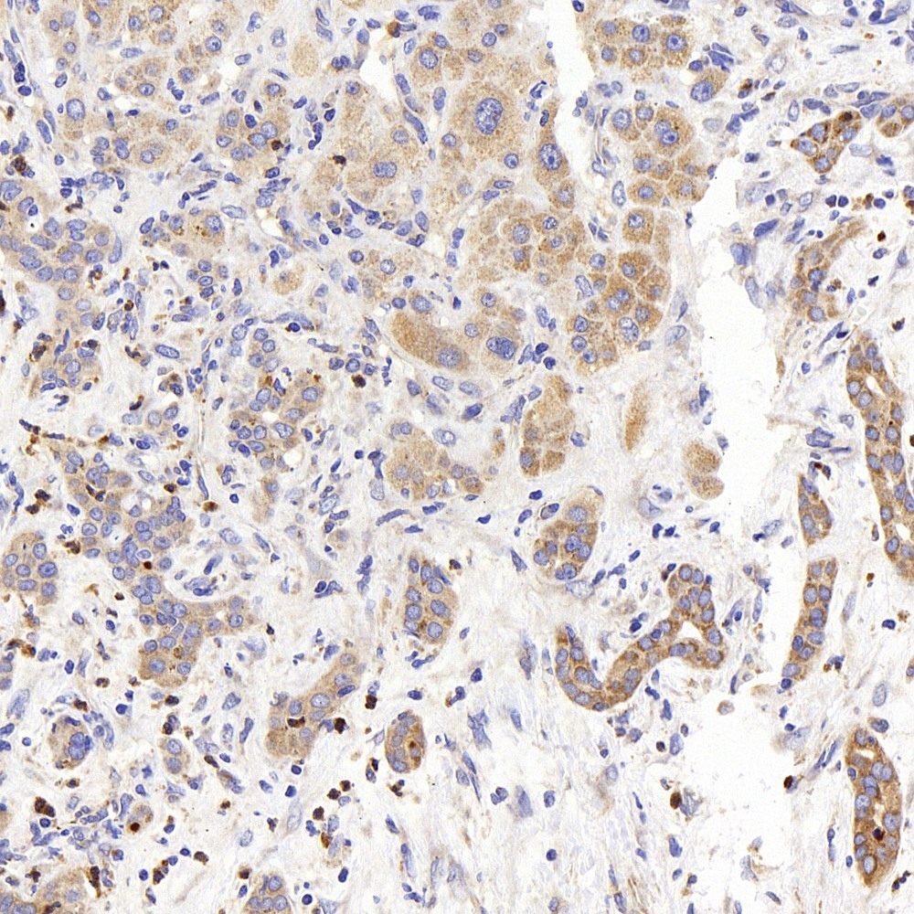 Immunohistochemistry analysis of paraffin-embedded human liver cancer  using PERK Polyclonal Antibody at dilution of 1:400.