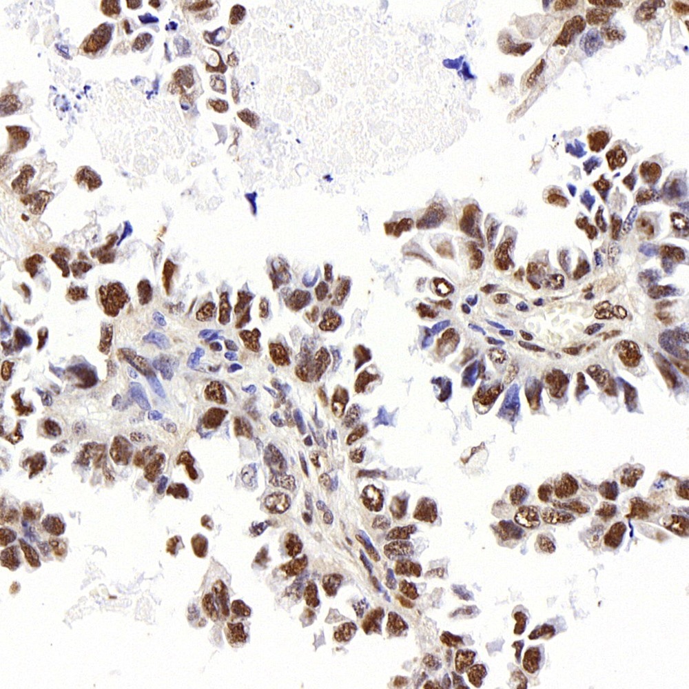 Immunohistochemistry analysis of paraffin-embedded human lung cancer  using Histone H4 Polyclonal Antibody at dilution of 1:400.