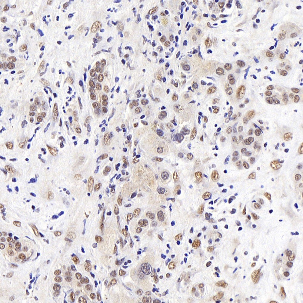 Immunohistochemistry analysis of paraffin-embedded human breast  using Histone H4 Polyclonal Antibody at dilution of 1:400.