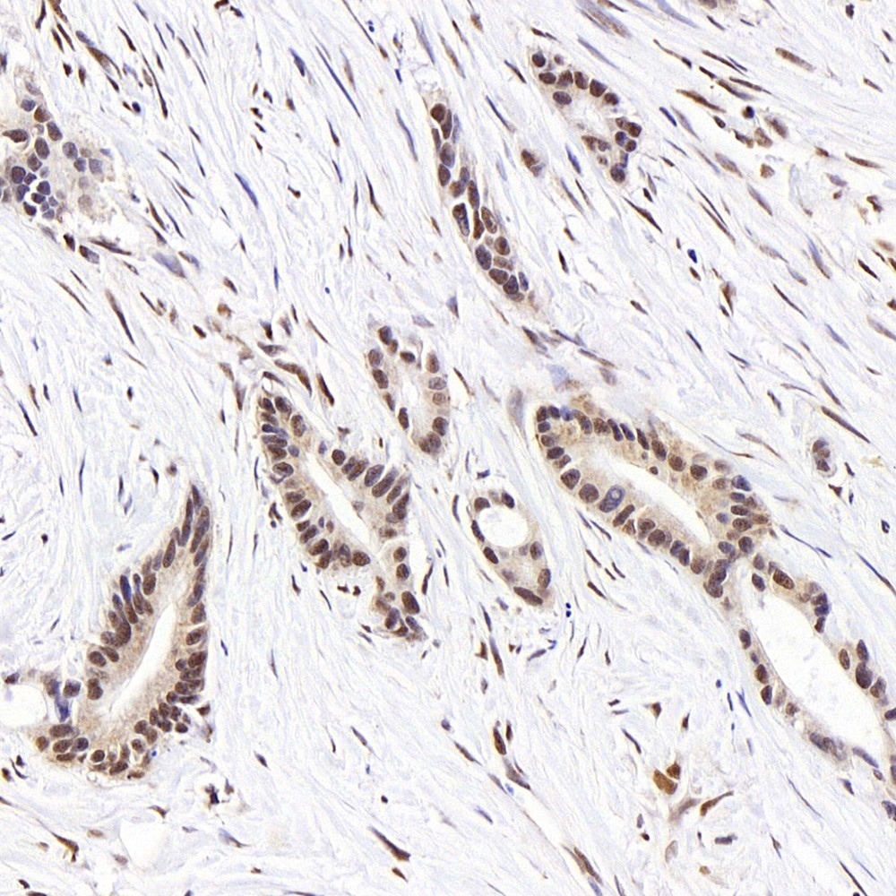 Immunohistochemistry analysis of paraffin-embedded human colon cancer  using Histone H4 Polyclonal Antibody at dilution of 1:400.