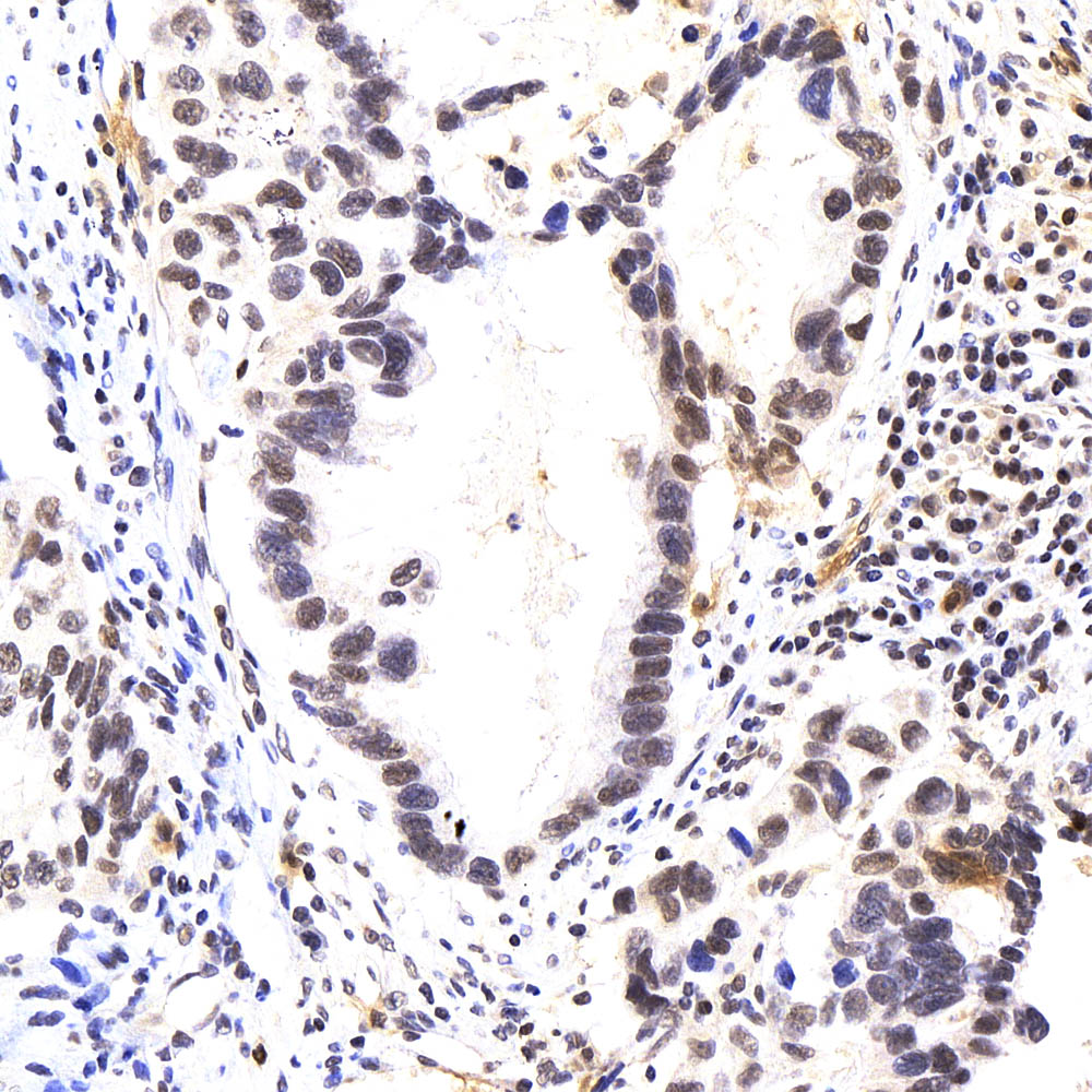 Immunohistochemistry analysis of paraffin-embedded human lung cancer  using p27 Polyclonal Antibody at dilution of 1:400.