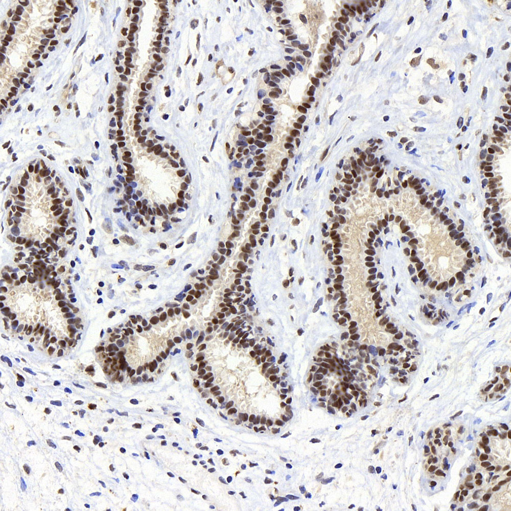 Immunohistochemistry analysis of paraffin-embedded human breast   using p27 Polyclonal Antibody at dilution of 1:400.