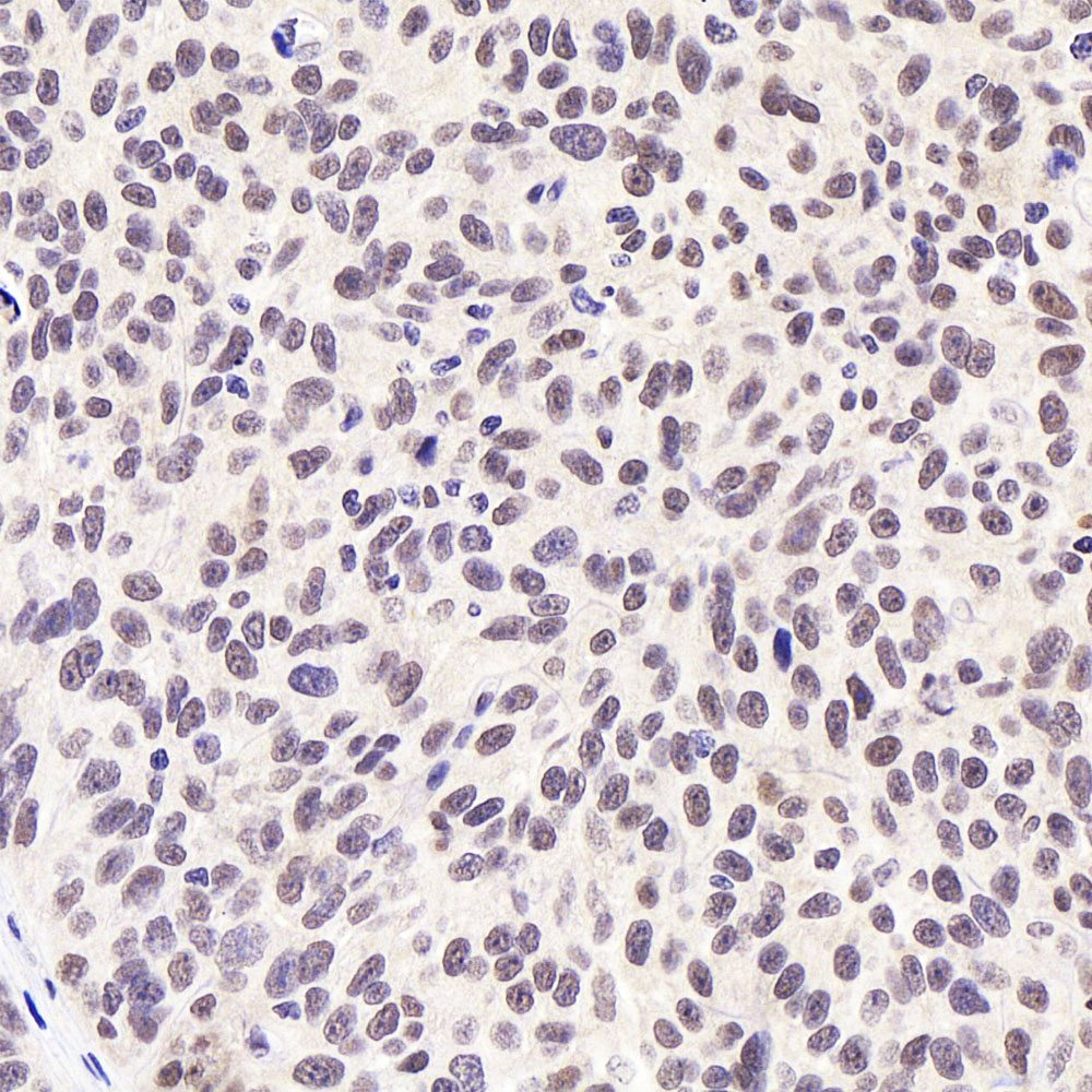 Immunohistochemistry analysis of paraffin-embedded human esophagi cancer  using p27 Polyclonal Antibody at dilution of 1:400.