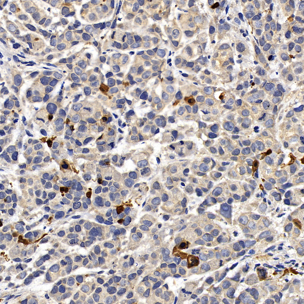 Immunohistochemistry analysis of paraffin-embedded A549 in Human breast  using CASP3 Polyclonal Antibody at dilution of 1:400.