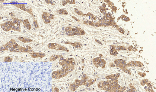 Immunohistochemistry of paraffin-embedded Human liver cancer tissue using CK-19 Polyclonal Antibody at dilution of 1:200.