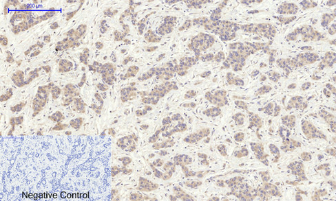 Immunohistochemistry of paraffin-embedded Human liver cancer tissue using EIF2 alpha Polyclonal Antibody at dilution of 1:200.