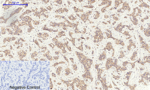 Immunohistochemistry of paraffin-embedded Human liver cancer tissue using GSK3 beta Polyclonal Antibody at dilution of 1:200.