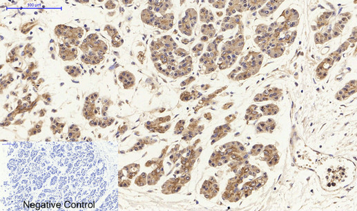 Immunohistochemistry of paraffin-embedded Human stomach cancer tissue using HSP27 Polyclonal Antibody at dilution of 1:200.