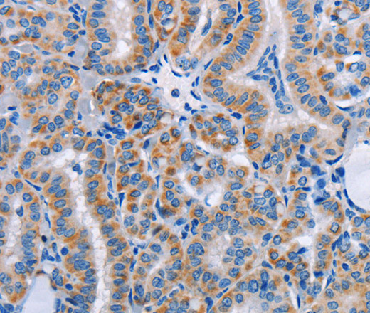 Immunohistochemistry of paraffin-embedded Human thyroid cancer tissue using FN1 Polyclonal Antibody at dilution 1:50