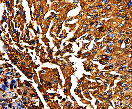 Immunohistochemistry of paraffin-embedded Human lung cancer using PKM Polyclonal Antibody at dilution of 1:50