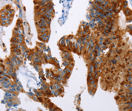 Immunohistochemistry of paraffin-embedded Human colon cancer tissue using TFF3 Polyclonal Antibody at dilution 1:50