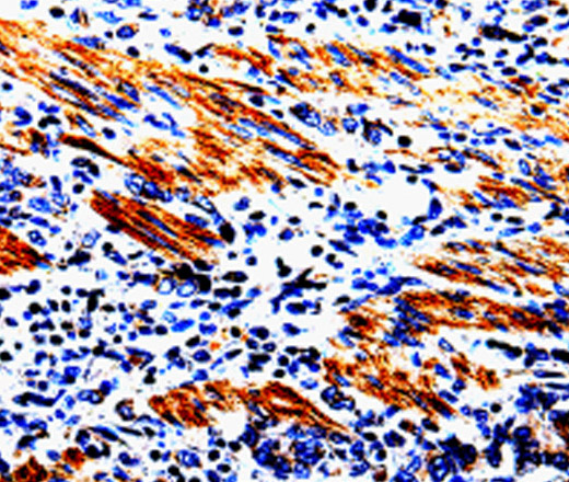 Immunohistochemistry of paraffin-embedded Human stomach cancer tissue using ACSBG2 Polyclonal Antibody at dilution 1:60