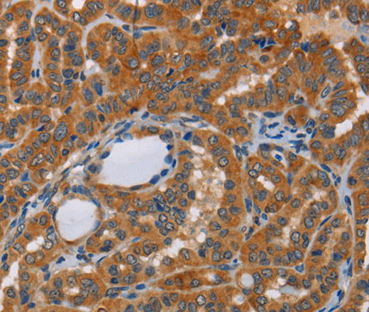Immunohistochemistry of paraffin-embedded Human thyroid cancer tissue using CK-13 Polyclonal Antibody at dilution 1:50