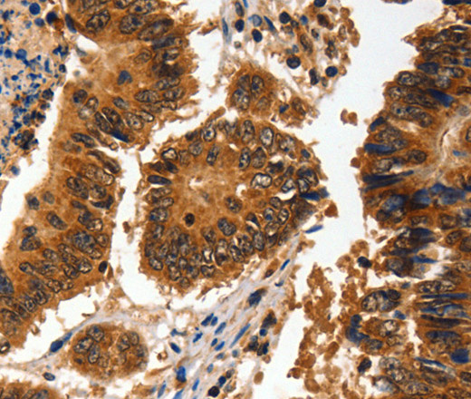 Immunohistochemistry of paraffin-embedded Human colon cancer using ADAP1 Polyclonal Antibody at dilution of 1:60