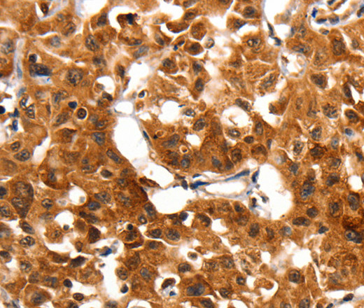 Immunohistochemistry of paraffin-embedded Human lung cancer using ADAP1 Polyclonal Antibody at dilution of 1:60