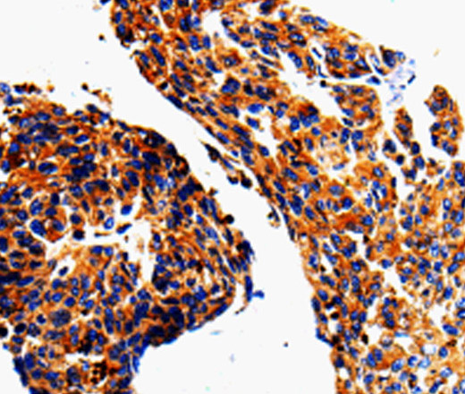 Immunohistochemistry of paraffin-embedded Human lung cancer tissue using ADD1 Polyclonal Antibody at dilution 1:50