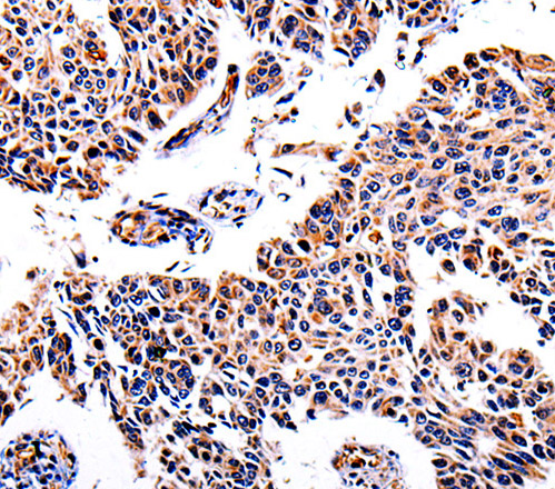 Immunohistochemistry of paraffin-embedded Human lung cancer  using AKR1B1 Polyclonal Antibody at dilution of 1:40