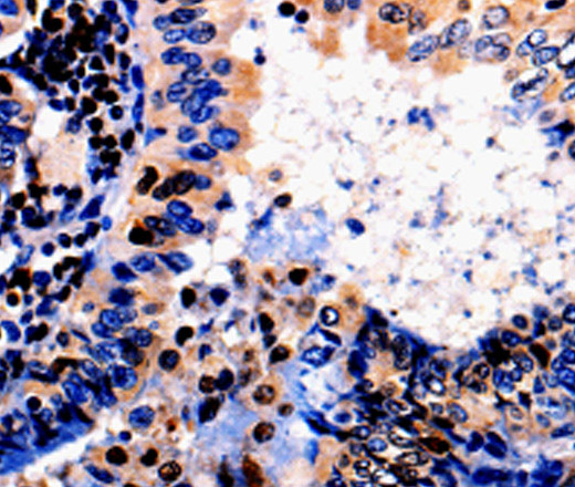 Immunohistochemistry of paraffin-embedded Human thyroid cancer tissue using ALOX5 Polyclonal Antibody at dilution 1:50