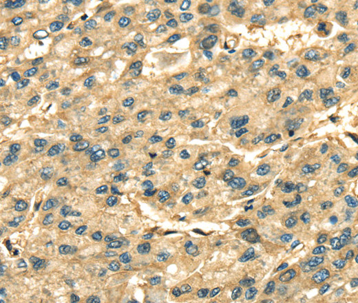 Immunohistochemistry of paraffin-embedded Human liver cancer using ANXA2 Polyclonal Antibody at dilution of 1:35