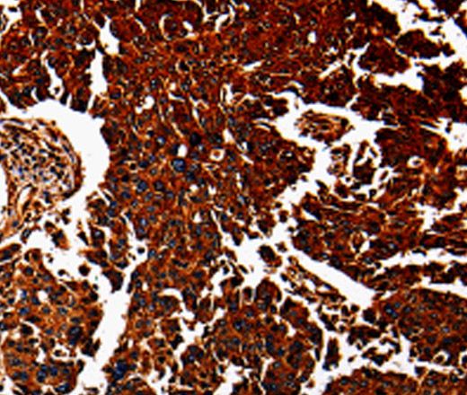 Immunohistochemistry of paraffin-embedded Human lung cancer tissue using ANXA7 Polyclonal Antibody at dilution 1:40