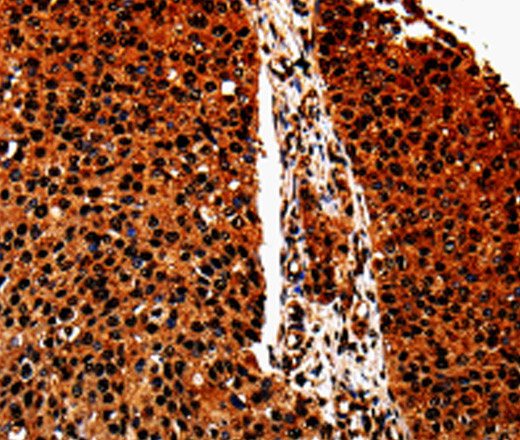 Immunohistochemistry of paraffin-embedded Human renal cancer tissue using ANXA7 Polyclonal Antibody at dilution 1:40