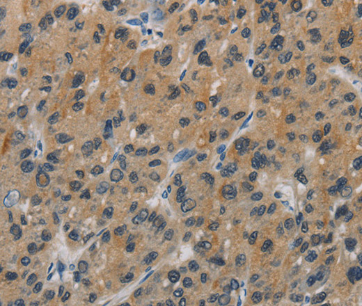 Immunohistochemistry of paraffin-embedded Human liver cancer tissue using CASP9 Polyclonal Antibody at dilution 1:60