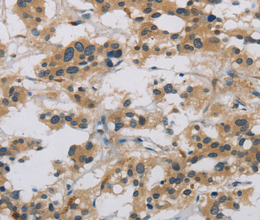 Immunohistochemistry of paraffin-embedded Human thyroid cancer tissue using CASP9 Polyclonal Antibody at dilution 1:60