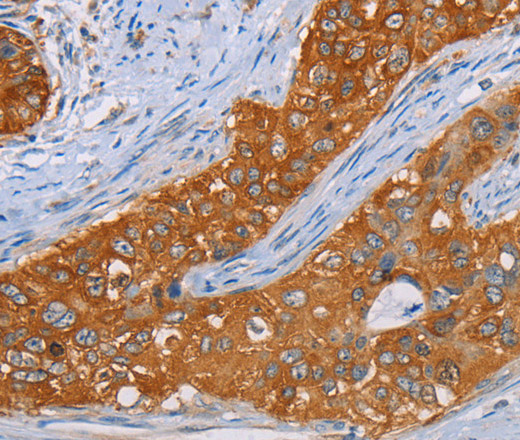 Immunohistochemistry of paraffin-embedded Human cervical cancer tissue using MMP1 Polyclonal Antibody at dilution 1:55