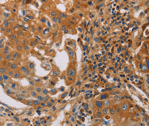 Immunohistochemistry of paraffin-embedded Human lung cancer tissue using MMP1 Polyclonal Antibody at dilution 1:55