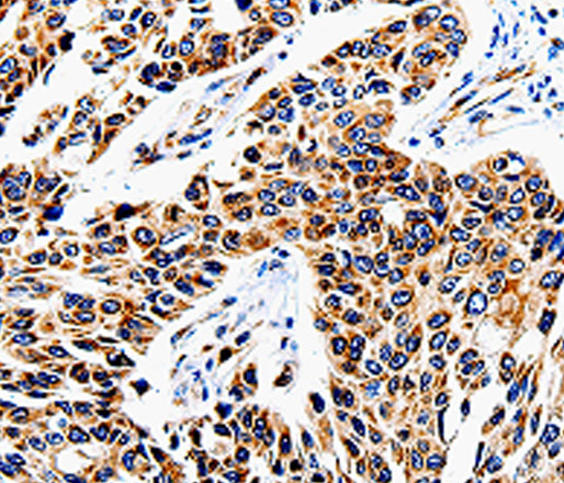 Immunohistochemistry of paraffin-embedded Human lung cancer tissue using COX16 Polyclonal Antibody at dilution 1:50