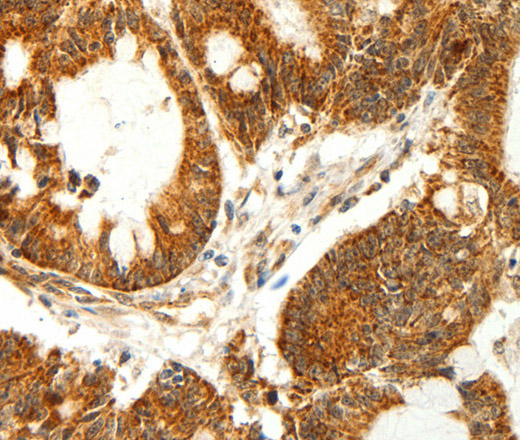 Immunohistochemistry of paraffin-embedded Human colon cancer using COX7B Polyclonal Antibody at dilution of 1:60