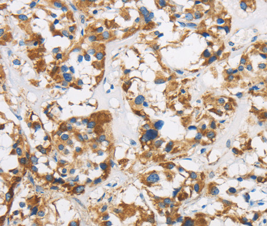 Immunohistochemistry of paraffin-embedded Human thyroid cancer using COX6B1 Polyclonal Antibody at dilution of 1:50