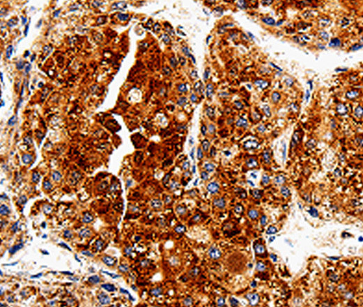 Immunohistochemistry of paraffin-embedded Human liver cancer tissue using COX19 Polyclonal Antibody at dilution 1:50