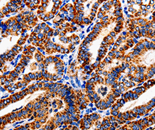 Immunohistochemistry of paraffin-embedded Human thyroid cancer tissue using COX19 Polyclonal Antibody at dilution 1:50