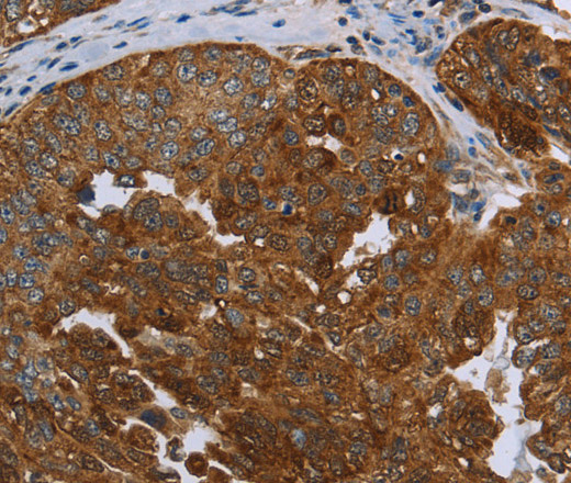 Immunohistochemistry of paraffin-embedded Human ovarian cancer using SNCG Polyclonal Antibody at dilution of 1:60