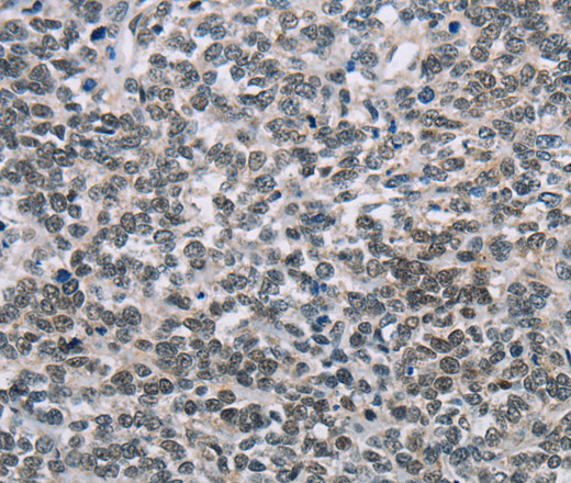 Immunohistochemistry of paraffin-embedded Human ovarian cancer tissue using TONSL Polyclonal Antibody at dilution 1:60