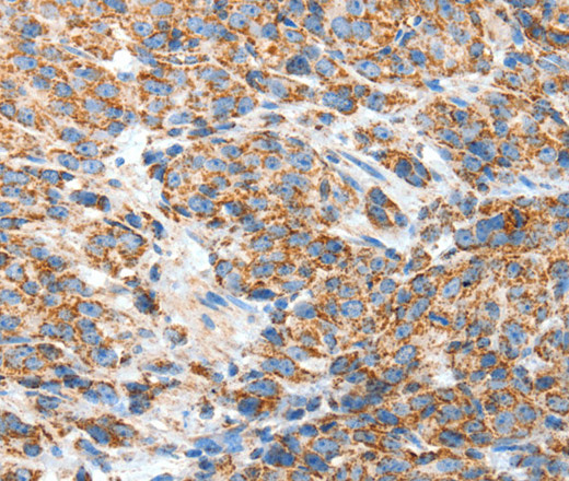 Immunohistochemistry of paraffin-embedded Human esophagus cancer using BAK1 Polyclonal Antibody at dilution of 1:50