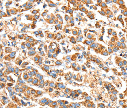 Immunohistochemistry of paraffin-embedded Human breast cancer using BAK1 Polyclonal Antibody at dilution of 1:50