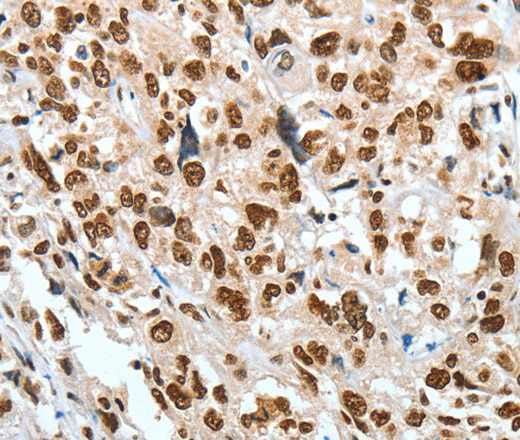 Immunohistochemistry of paraffin-embedded Human esophagus cancer using BNIP1 Polyclonal Antibody at dilution of 1:60