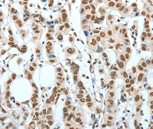 Immunohistochemistry of paraffin-embedded Human breast cancer using BNIP1 Polyclonal Antibody at dilution of 1:60